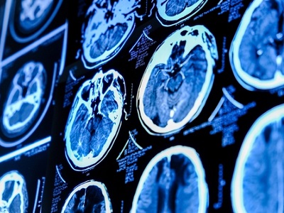 Close-up of medical brain scan images on a screen, showing detailed CT or MRI scans of the human brain in blue tones, representing AI use in healthcare diagnostics.